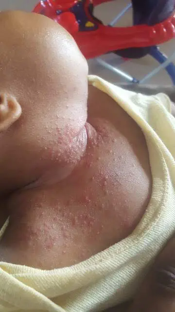 kiddiesquare-baby rash
