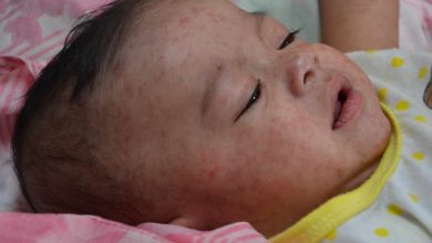 Photo of Severe Rash Under Baby Neck: Types, Causes, Treatment and Home Remedy