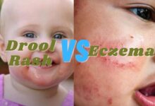 Photo of Drool rash vs Eczema