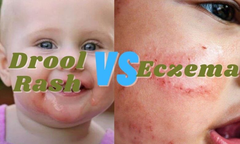 Drool Rash Vs Eczema How To Identify And Difference Between Drool Rash And Eczema Kiddiesquare