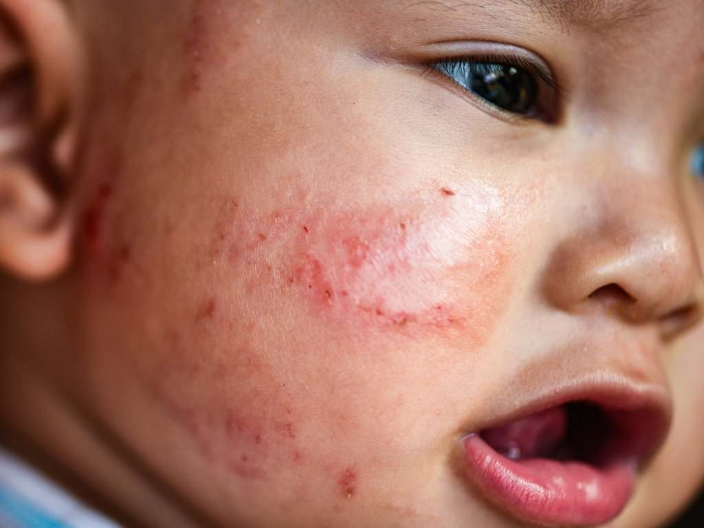 eczema- baby-face